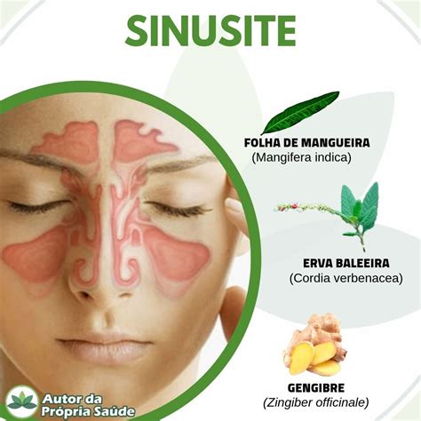 O Que Pode Causar A Sinusite