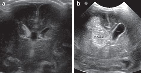 Severe Intraventricular Hemorrhage Ivh Coronal Ultrasounds At