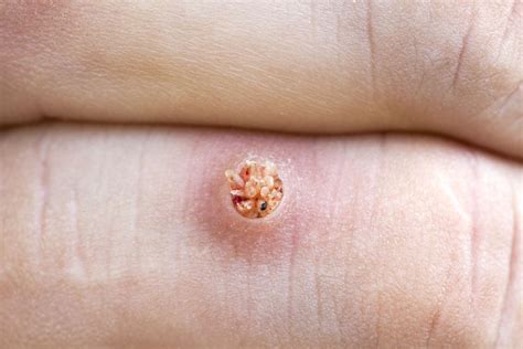 What Is A Wart And How Do I Get Rid Of It 2023