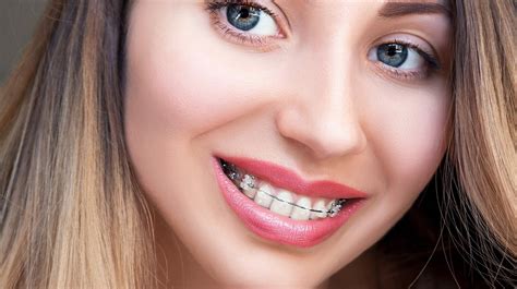 Dental Midline Dental Midline Definition Correcting Dental Midline