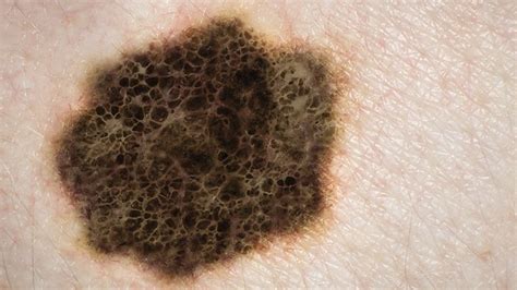 Use Your Abcde To Spot Deadly Skin Cancer Everyday Health