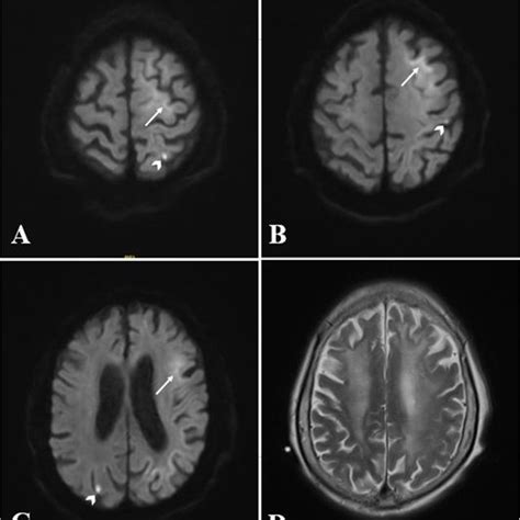 Brain Mri Findings In An 86 Year Old Patient With Niid Brain Mri