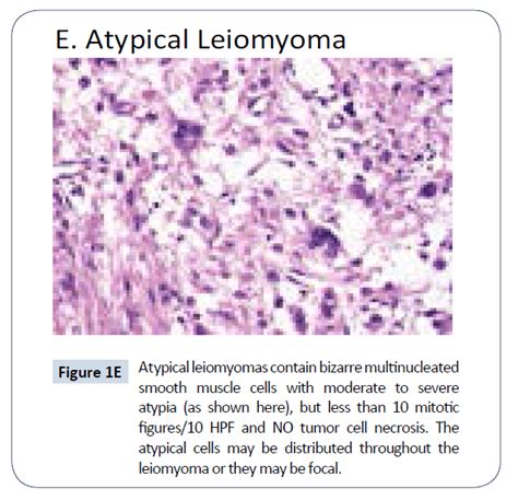 Uterine Smooth Muscle Tumors Of Uncertain Malignant Potential St