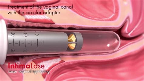 Everything You Need To Know About Vaginal Rejuvenation Sl Aesthetic