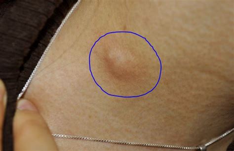 Lump Under Armpit Painful Hard Male Female Sore Small Red Swollen