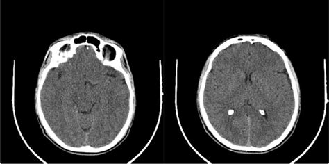 A And B Showing Normal Head Ct Scans Download Scientific Diagram