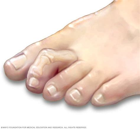 Hammertoe And Mallet Toe Disease Reference Guide