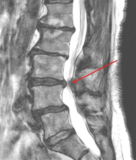 Could You Have Spinal Stenosis Make The Diagnosis And Treat It