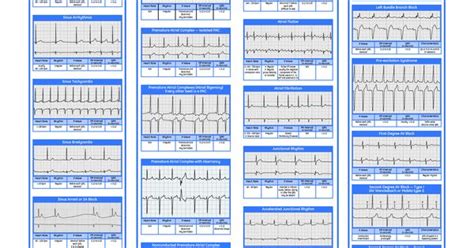 Dysrhythmia Interpretation Yahoo Search Results Arrathym