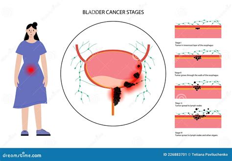 Bladder Cancer Stages Stock Vector Illustration Of Urethra 226883701