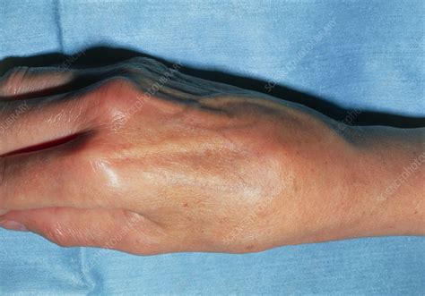 Swollen Right Hand Due To Osteoarthritis In Wrist Stock Image M110