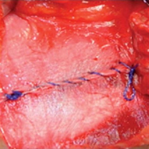 Pdf No Mesh Inguinal Hernia Repair With Continuous Absorbable Sutures