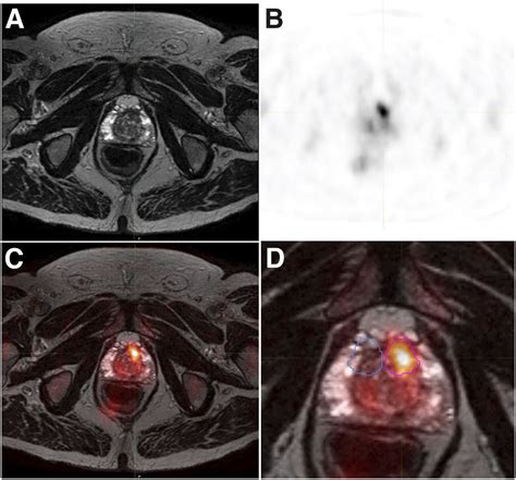 18f Choline Petmri The Additional Value Of Pet For Mri Guided