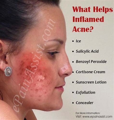 What Helps Inflamed Acne