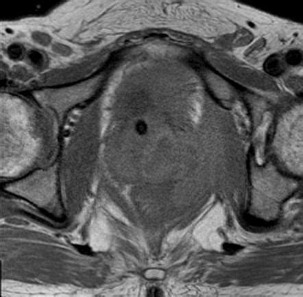 Prostatic Abscess Mri Radiology Case Radiopaedia Org