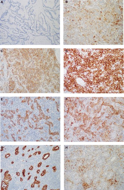 Representative Images Of Pd L1 Immunostaining Pd L1 Was Immunostained