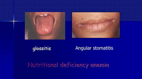 Ppt Approach To Anemia Powerpoint Presentation Free Download Id513188
