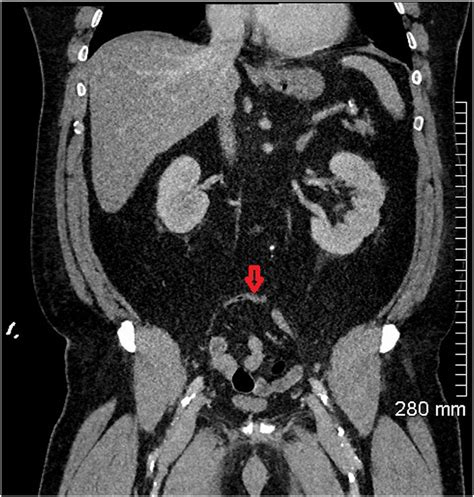 Coronal Ct Abdomen Showing A Normal Appendix On Admission Red Arrow