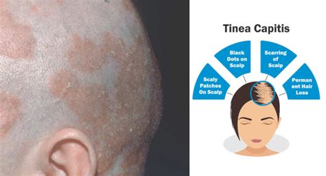 Treatment Of Tinea Corporis Fungus Therapy