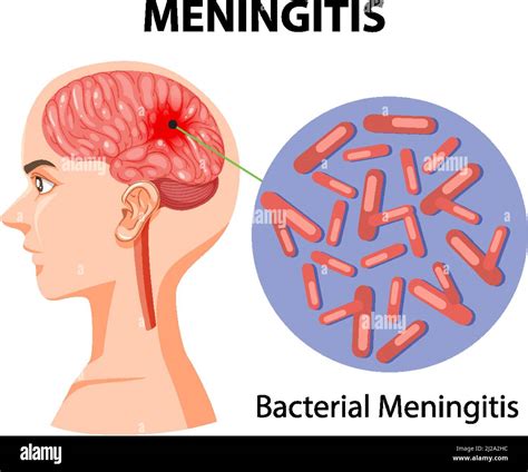 Diagrama Que Muestra La Meningitis En La Ilustración Humana Imagen Vector De Stock Alamy