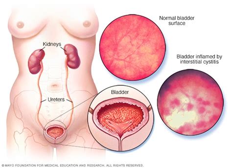 Interstitial Cystitis Symptoms Causes Mayo Clinic
