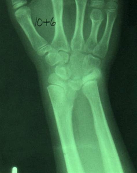 Madelungs Deformity Hand Orthobullets