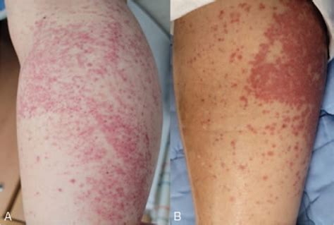 Iga Vasculitis Mimicking Drug Induced Skin Reaction And Infe Medicine