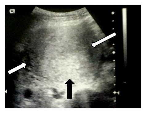 A Transabdominal Sagittal Sonogram Showing A Mirror Image Of The