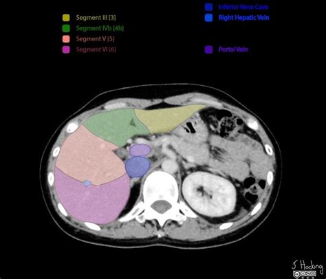 Liver segments: annotated CT | Radiology Case | Radiopaedia.org | Liver