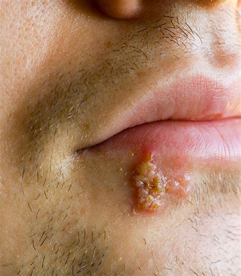 Maybe you would like to learn more about one of these? Photos of Cold Sores on Lips - Stop Cold Sores