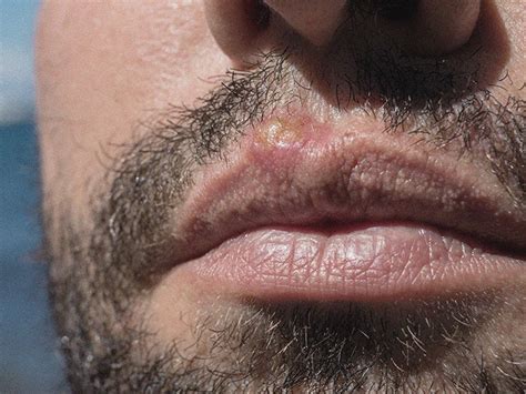 Herpes On Upper Lip