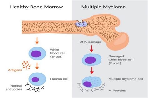 Multiple Myeloma Definition Symptoms Causes Diagnosis Types