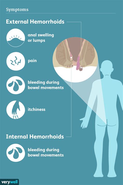 Hemorrhoids Signs Symptoms And Complications