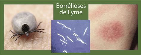 Borrélioses De Lyme Maladies Infectieuses Complexes Santé Vivante