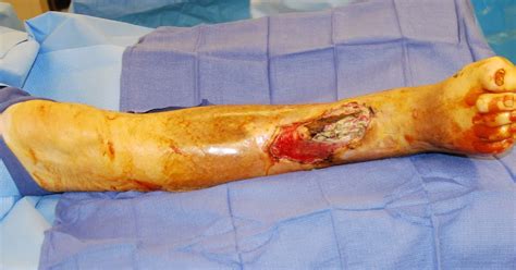 Flap Surgery: Autologous Tissue, Wounds, Microvascular ...