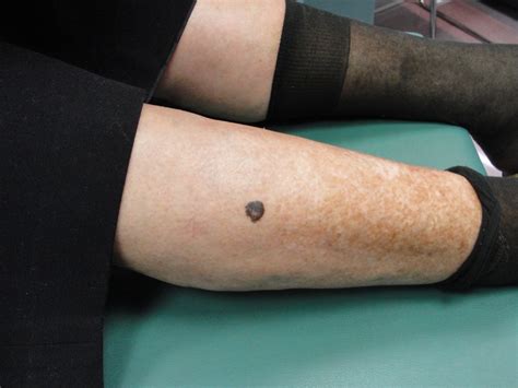 Signs Of Skin Cancer On Leg