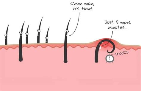 Testosterone levels out in the early 20's. How To Get Rid Of Ingrown Facial Hair (Causes, Prevention ...