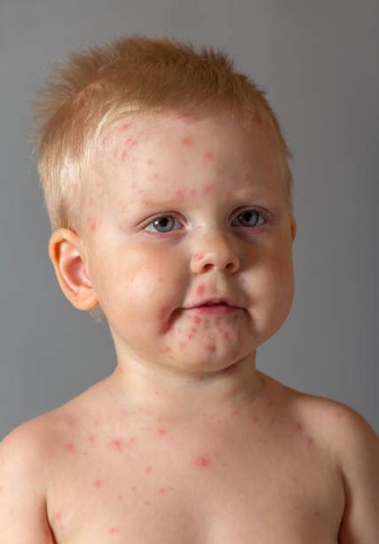 910 Skin Rash Face Stock Photos Pictures And Royalty Free Images Istock