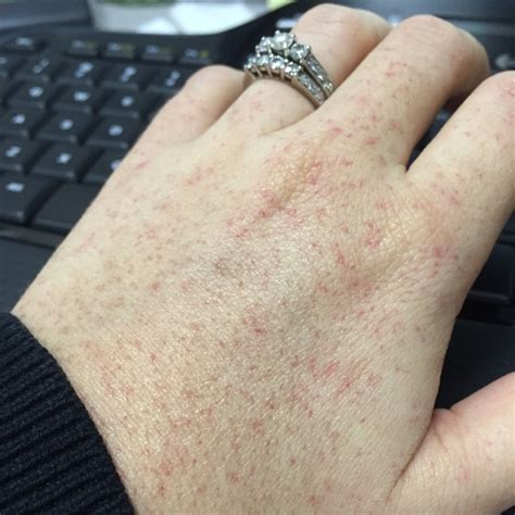 Any One Else Have Petechiae Ive Had Them My Entire Life On My Hand