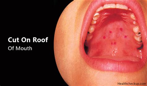 Cut On Roof Of Mouth Causes Treatment Prevention By Dr Himanshi