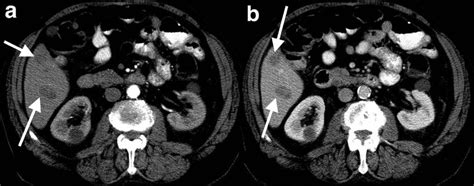 Hypovascular Gist Liver Metastases Multiphase Ct Images Demonstrates