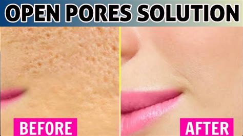 How To Minimise Large Open Pores How To Shrink Open Pores 100 Results Youtube