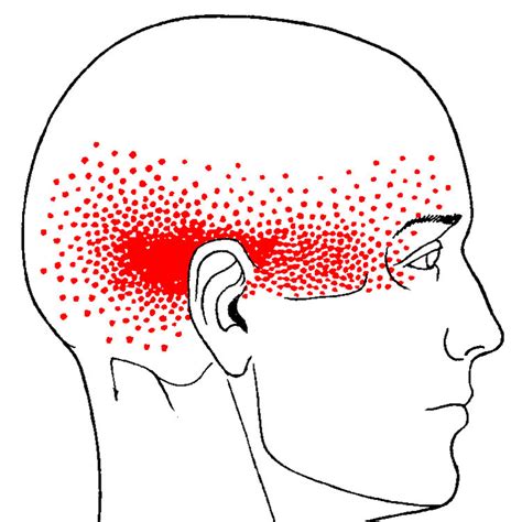 Cervicogenic Headache Trigger Point Works West Suburban Pain Relief
