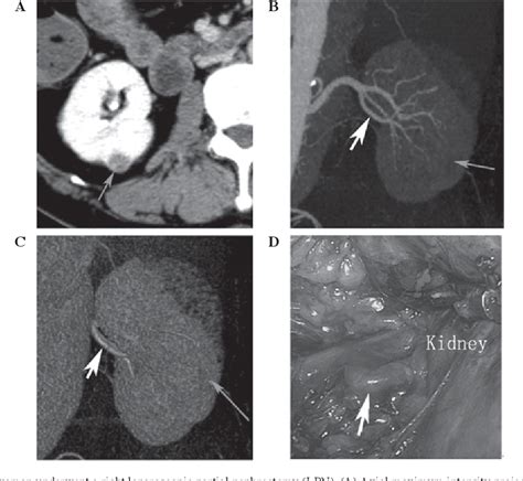 Figure 2 From Preoperative Evaluation Of Renal Artery Anatomy Using