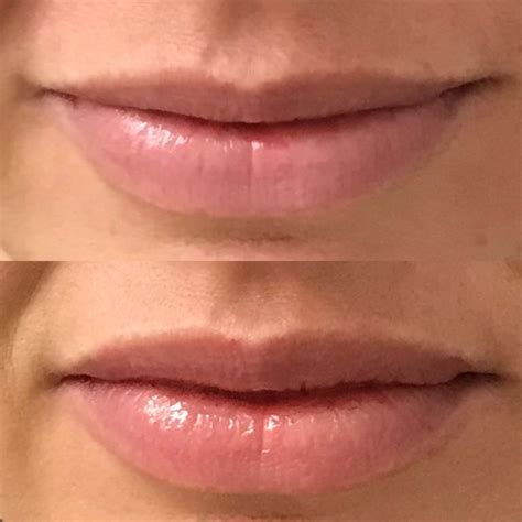 Botox Lip Flip Overview Artemedica