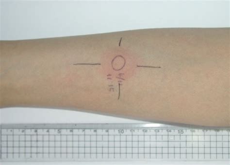 Tuberculin Test Was Performed After The Patient Was Stabilized With