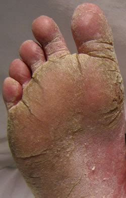 Athlete S Foot Fungus