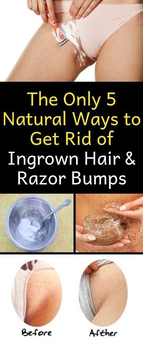 how to get rid of razor bumps on bikini area naturally alorabarbie