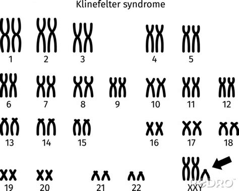 Fototapeta Scheme Of Klinefelter Syndrome Karyotype Of Human Somatic