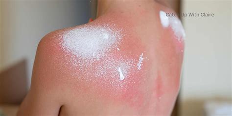 How To Treat Sunburn What To Do To Help Sunburn